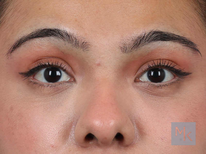 Lower Blepharoplasty Before and After | Dr. Michael Kim