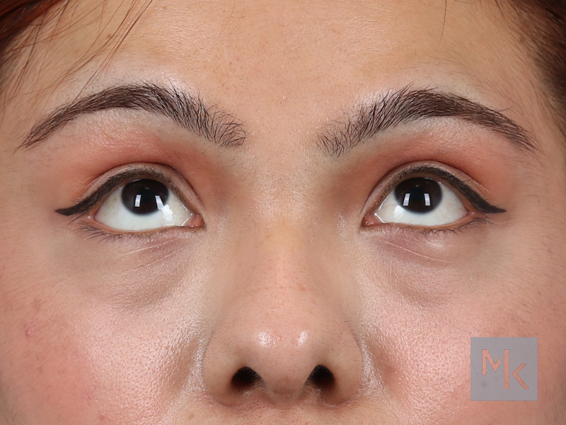 Lower Blepharoplasty Before and After | Dr. Michael Kim