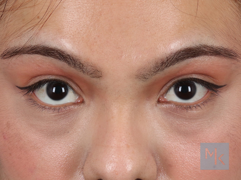 Lower Blepharoplasty Before and After | Dr. Michael Kim