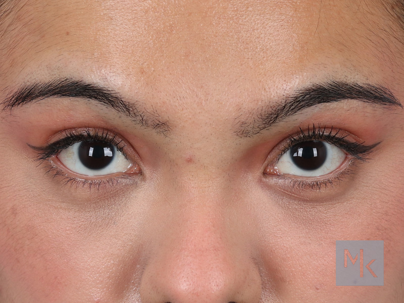 Lower Blepharoplasty Before and After | Dr. Michael Kim