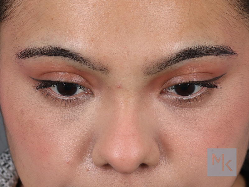 Lower Blepharoplasty Before and After | Dr. Michael Kim
