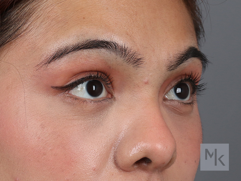 Lower Blepharoplasty Before and After | Dr. Michael Kim