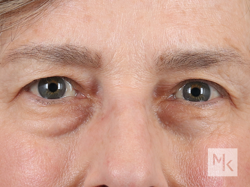 Lower Blepharoplasty Before and After | Dr. Michael Kim