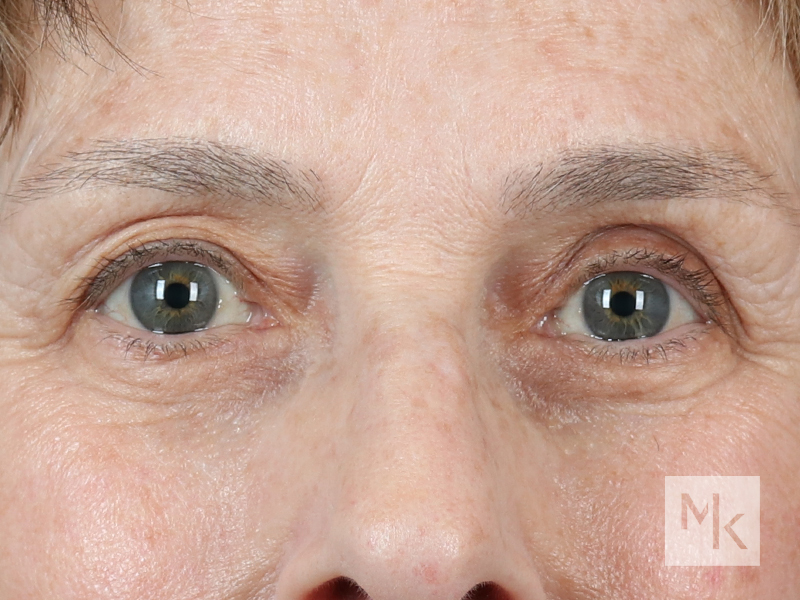 Lower Blepharoplasty Before and After | Dr. Michael Kim