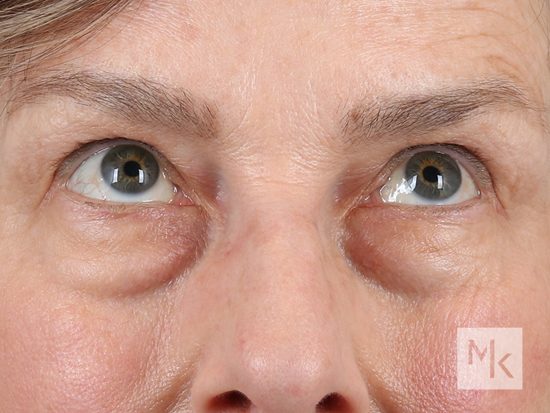 Lower Blepharoplasty Before and After | Dr. Michael Kim