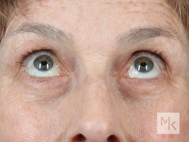 Lower Blepharoplasty Before and After | Dr. Michael Kim