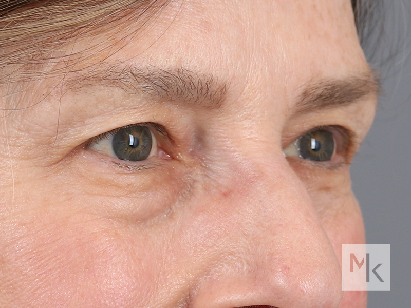 Lower Blepharoplasty Before and After | Dr. Michael Kim