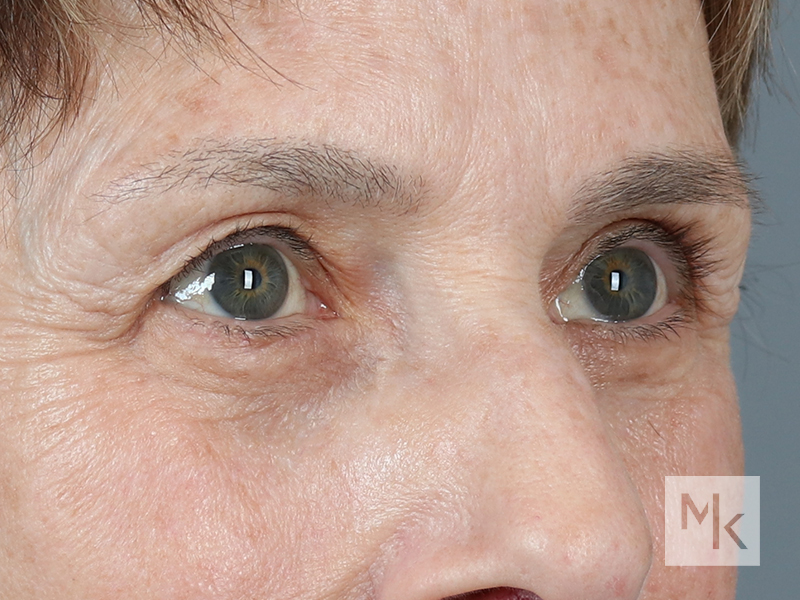 Lower Blepharoplasty Before and After | Dr. Michael Kim
