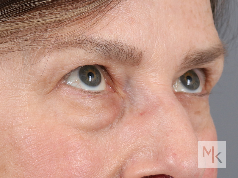 Lower Blepharoplasty Before and After | Dr. Michael Kim