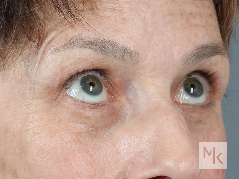 Lower Blepharoplasty Before and After | Dr. Michael Kim