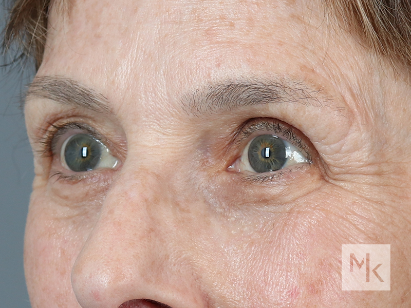 Lower Blepharoplasty Before and After | Dr. Michael Kim
