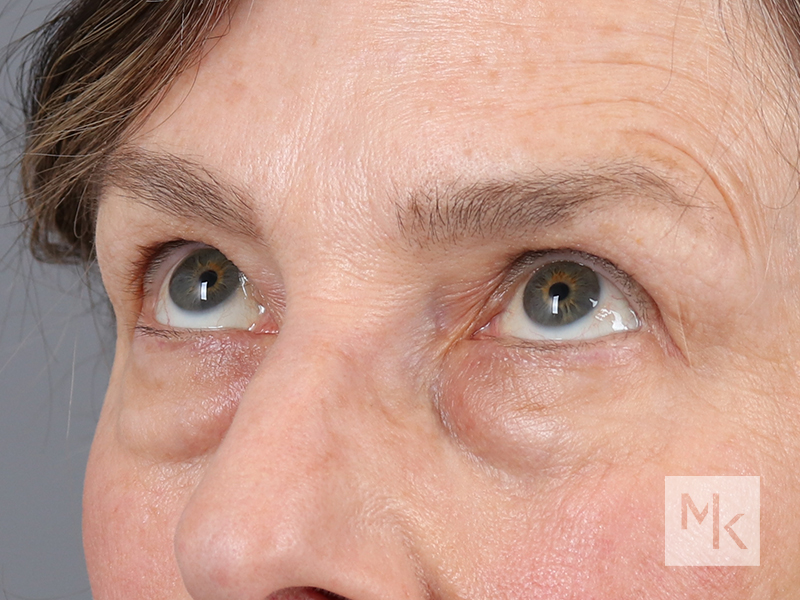 Lower Blepharoplasty Before and After | Dr. Michael Kim