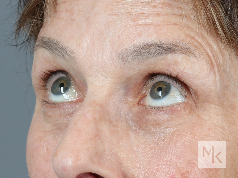 Lower Blepharoplasty Before and After | Dr. Michael Kim