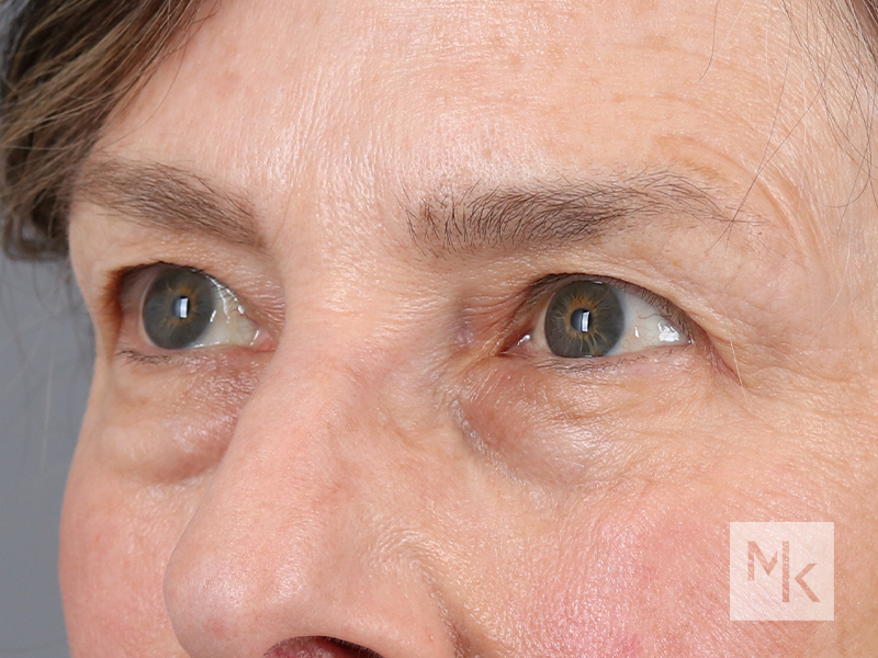 Lower Blepharoplasty Before and After | Dr. Michael Kim