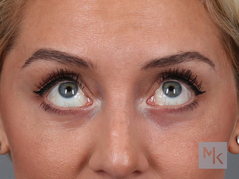 Lower Blepharoplasty Before and After | Dr. Michael Kim