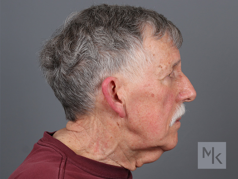 Neck Lift Before and After | Dr. Michael Kim