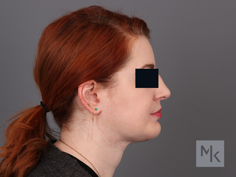 Neck Lift Before and After | Dr. Michael Kim
