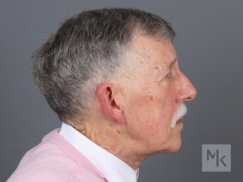 Neck Lift Before and After | Dr. Michael Kim