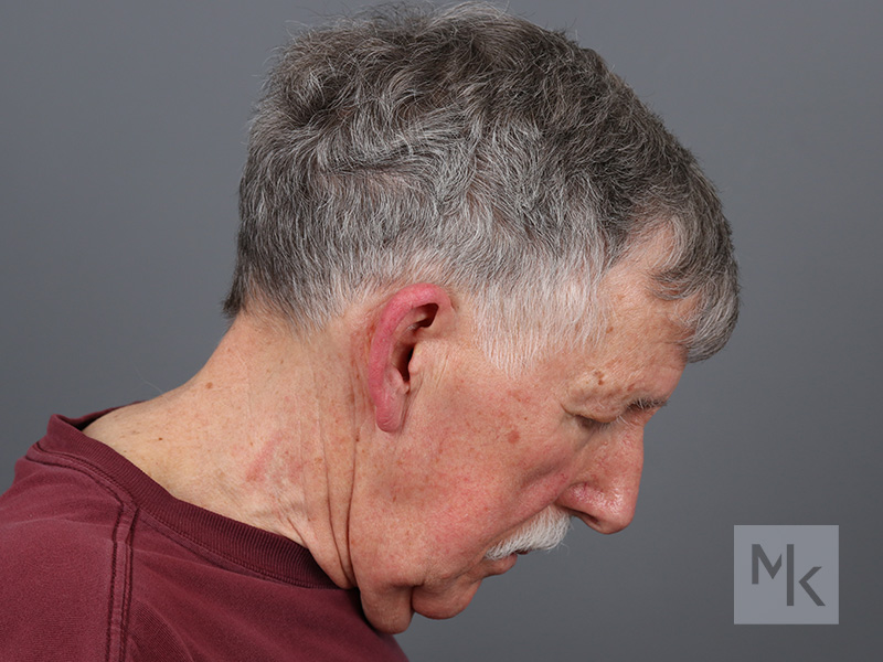 Neck Lift Before and After | Dr. Michael Kim