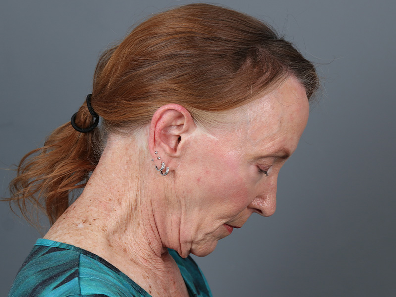 Neck Lift Before and After | Dr. Michael Kim