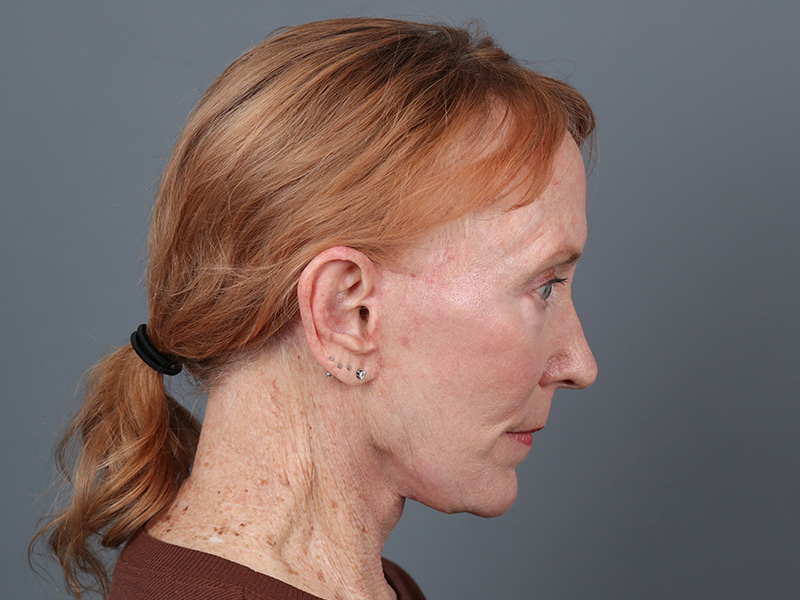 Neck Lift Before and After | Dr. Michael Kim