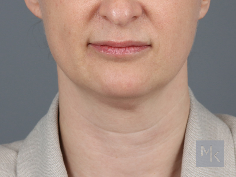 Neck Lift Before and After | Dr. Michael Kim