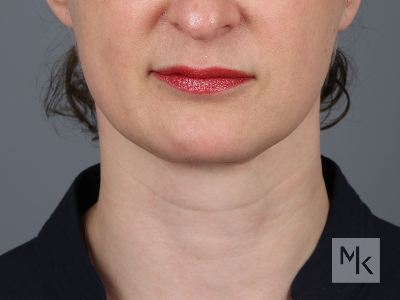 Neck Lift Before and After | Dr. Michael Kim