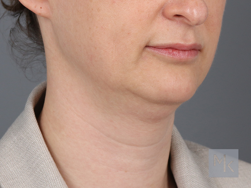 Neck Lift Before and After | Dr. Michael Kim