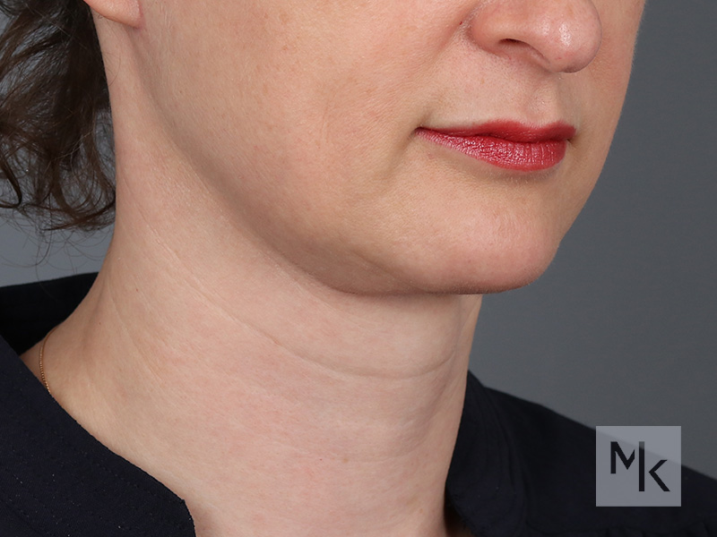 Neck Lift Before and After | Dr. Michael Kim