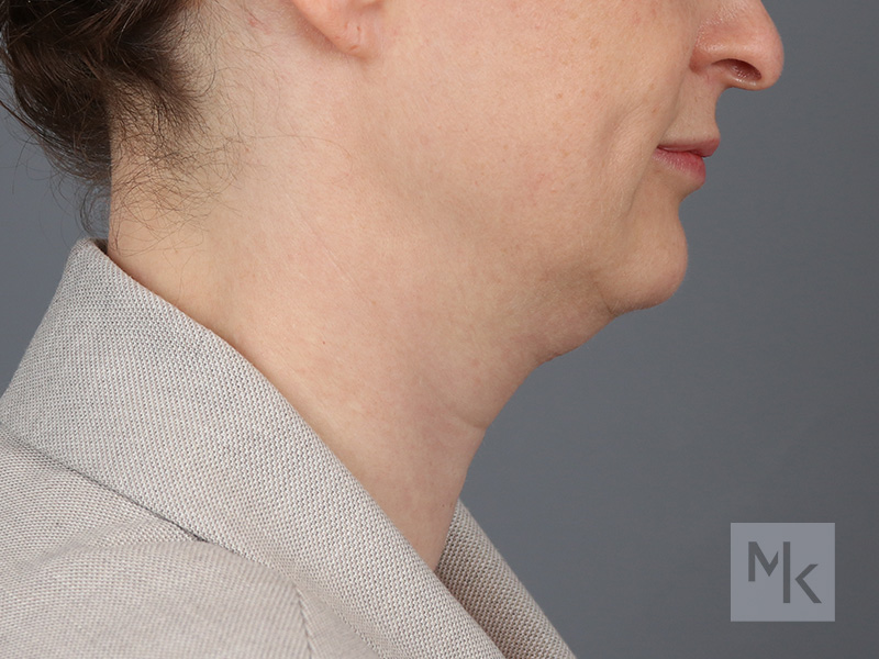 Neck Lift Before and After | Dr. Michael Kim