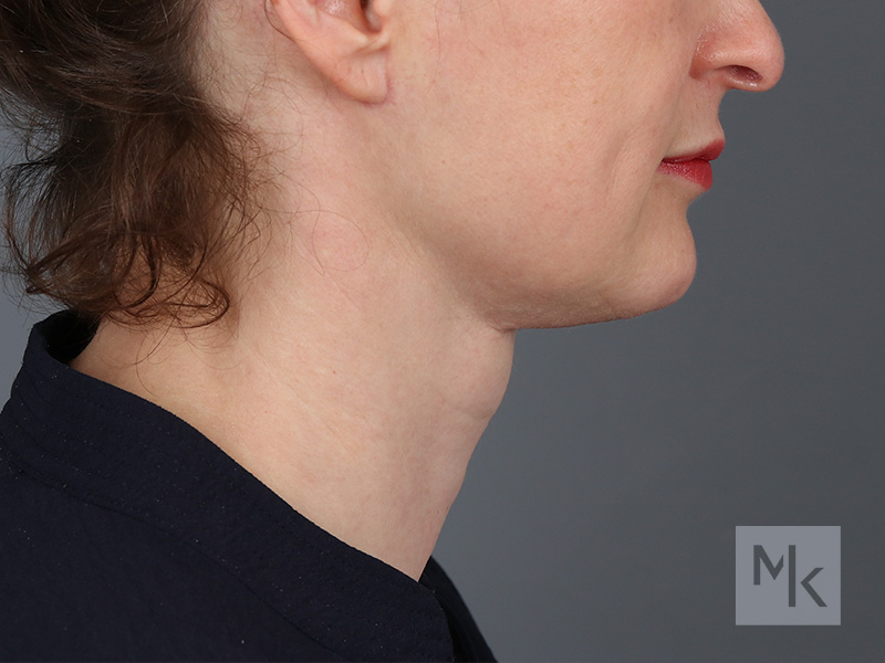Neck Lift Before and After | Dr. Michael Kim