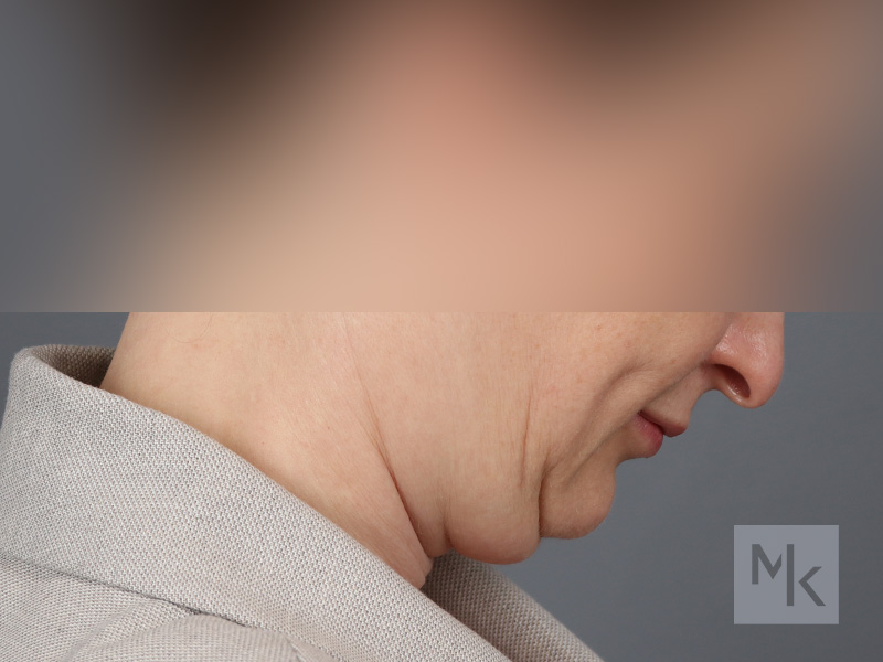 Neck Lift Before and After | Dr. Michael Kim