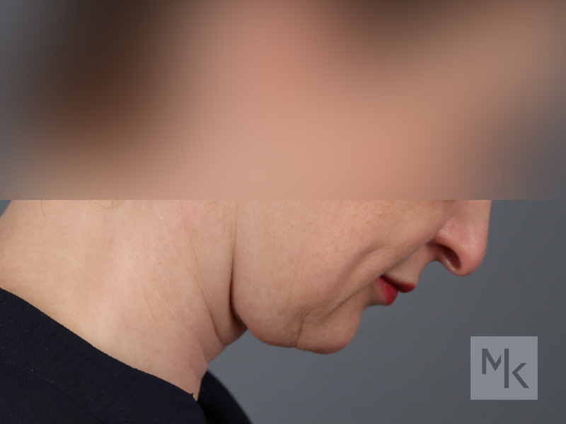 Neck Lift Before and After | Dr. Michael Kim