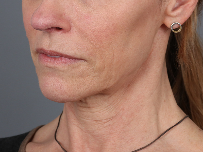 Neck Lift Before and After | Dr. Michael Kim