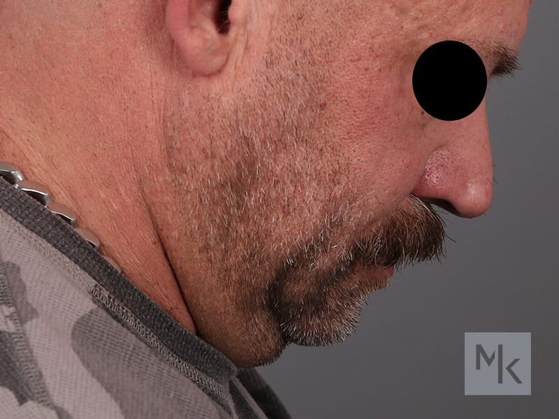 Neck Lift Before and After | Dr. Michael Kim