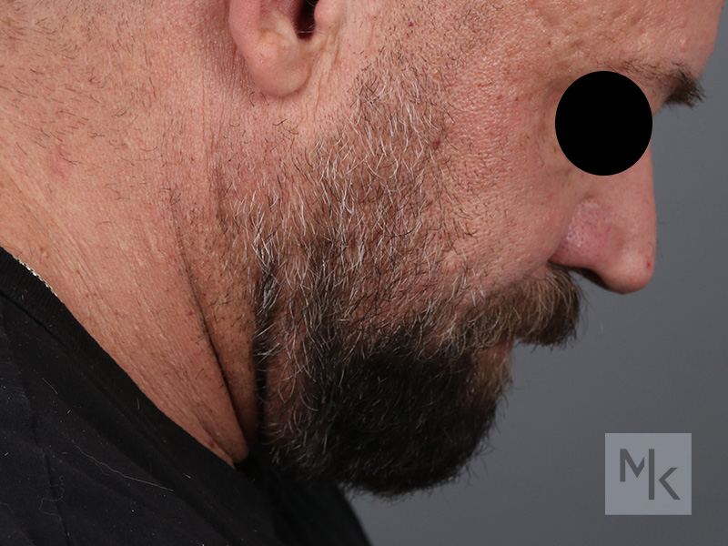 Neck Lift Before and After | Dr. Michael Kim