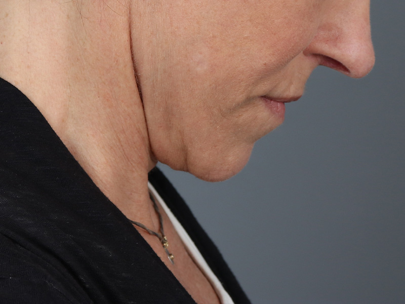 Neck Lift Before and After | Dr. Michael Kim
