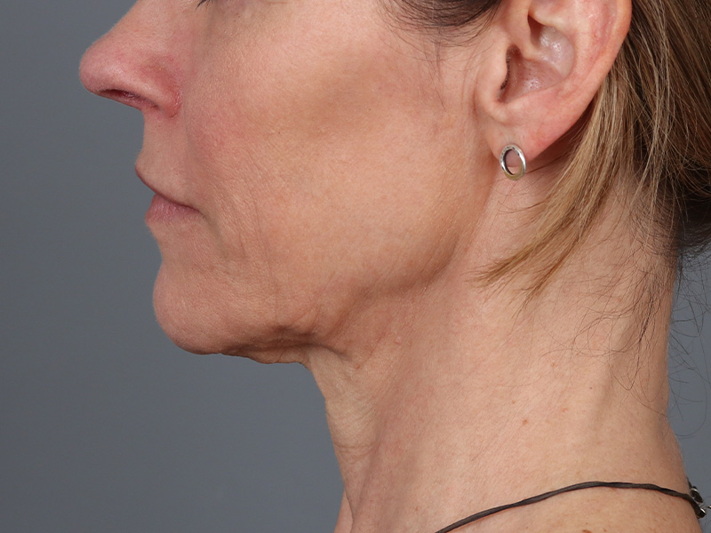 Neck Lift Before and After | Dr. Michael Kim