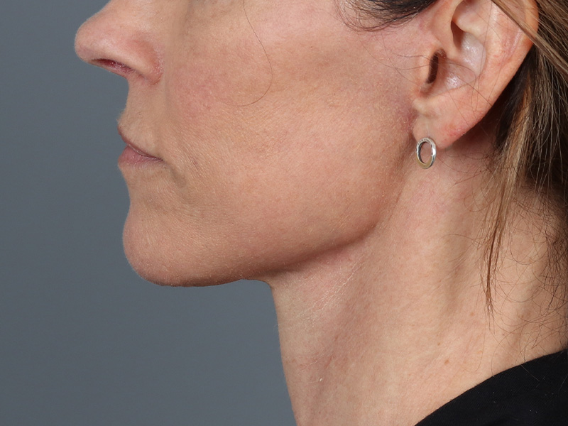 Neck Lift Before and After | Dr. Michael Kim