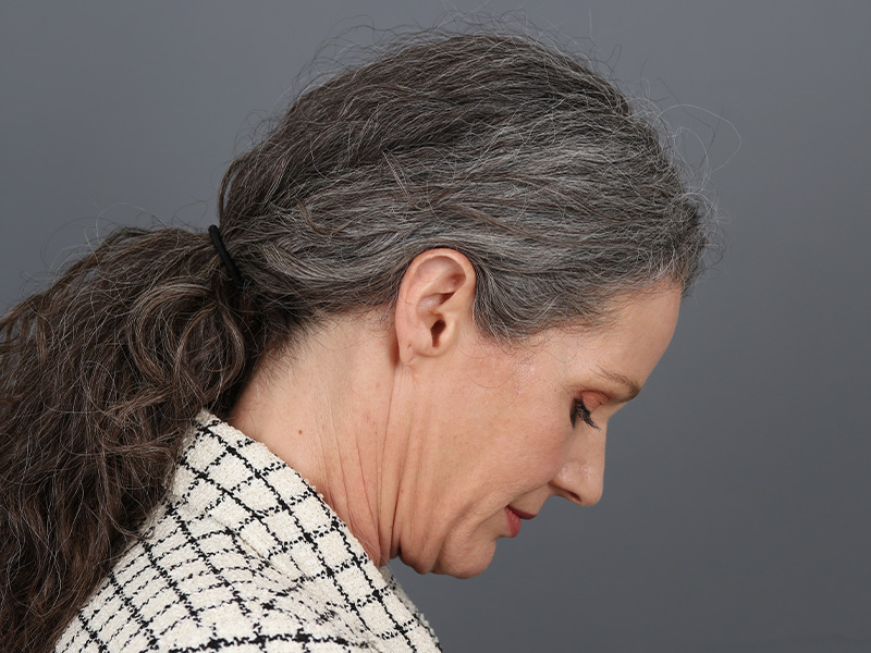 Neck Lift Before and After | Dr. Michael Kim