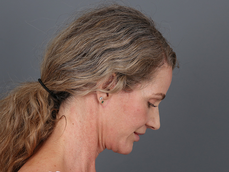 Neck Lift Before and After | Dr. Michael Kim