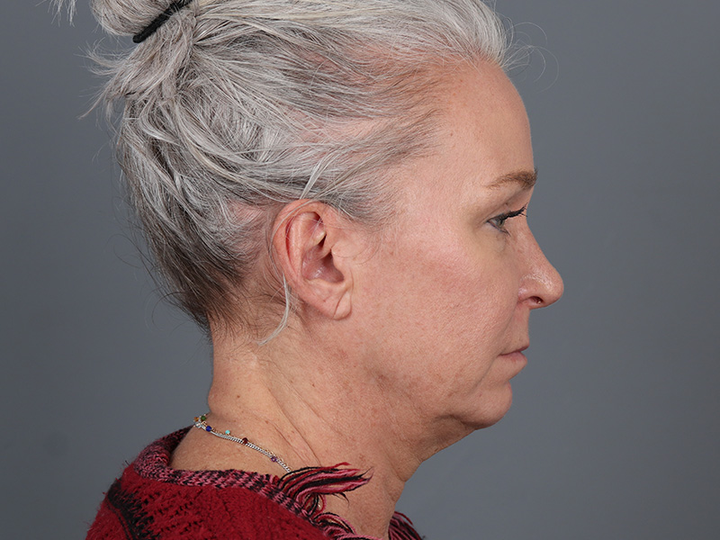 Neck Lift Before and After | Dr. Michael Kim