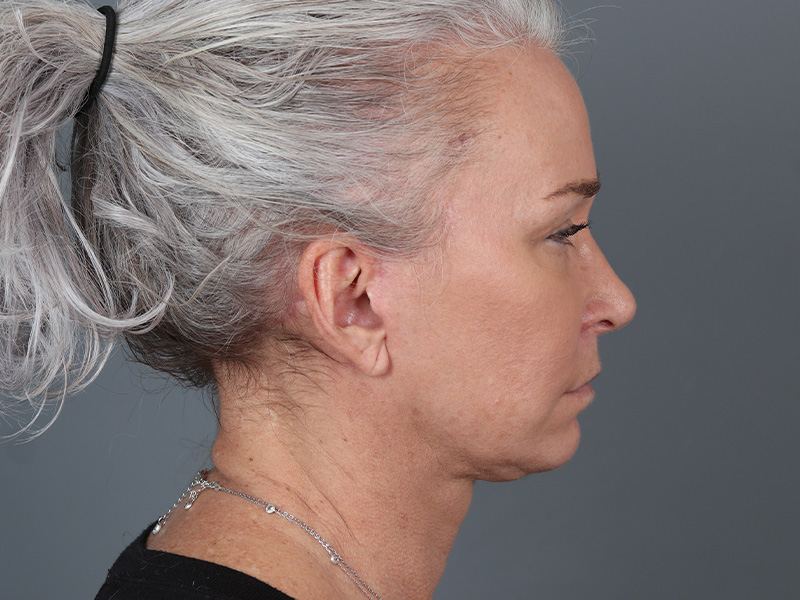 Neck Lift Before and After | Dr. Michael Kim