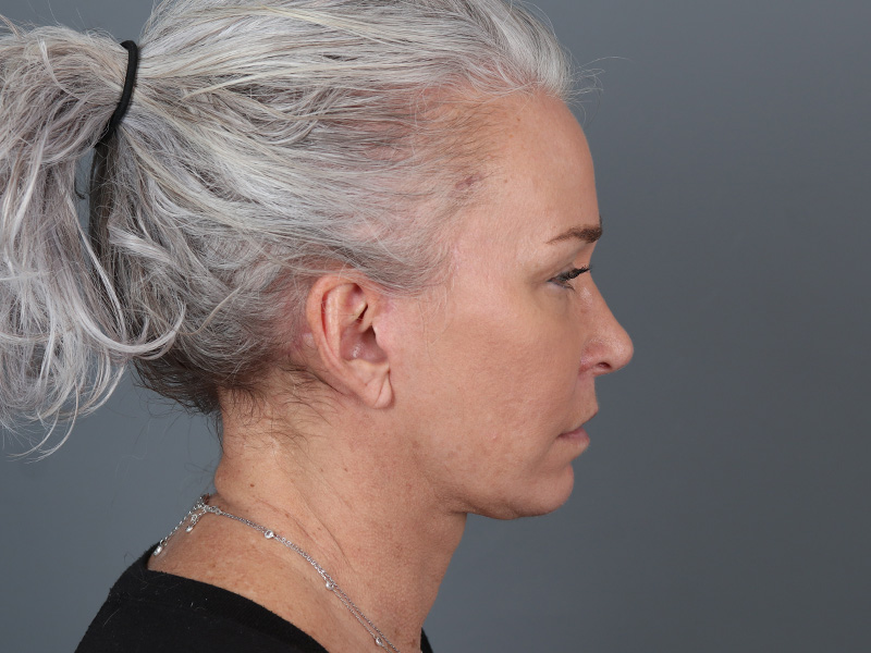 Neck Lift Before and After | Dr. Michael Kim