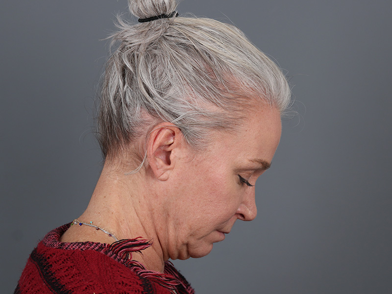 Neck Lift Before and After | Dr. Michael Kim