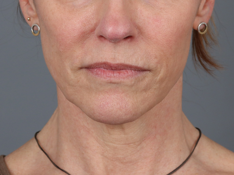 Neck Lift Before and After | Dr. Michael Kim