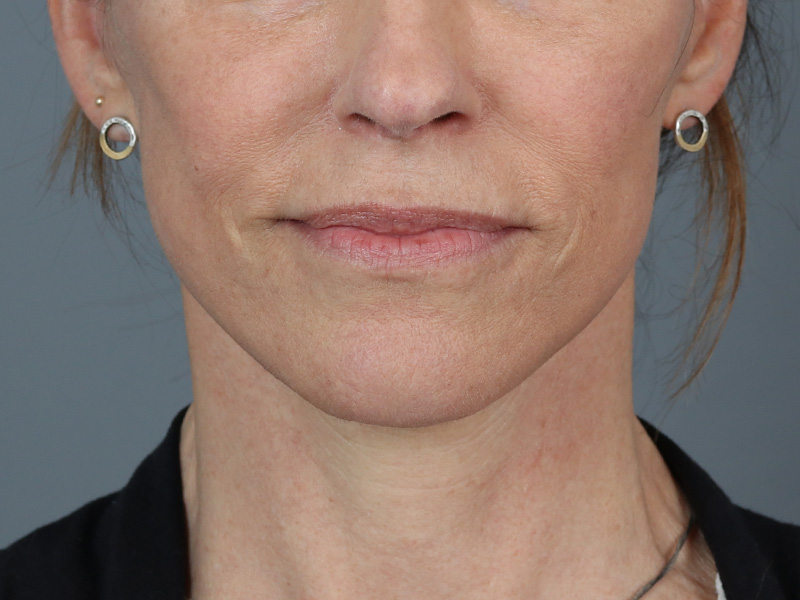 Neck Lift Before and After | Dr. Michael Kim