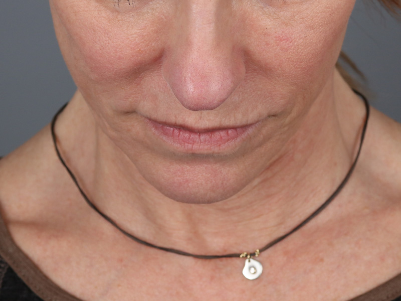 Neck Lift Before and After | Dr. Michael Kim
