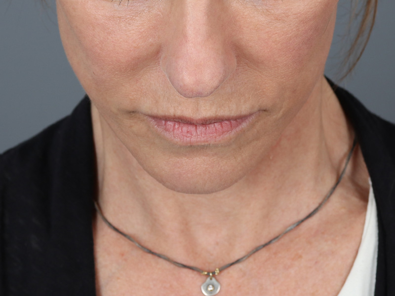 Neck Lift Before and After | Dr. Michael Kim
