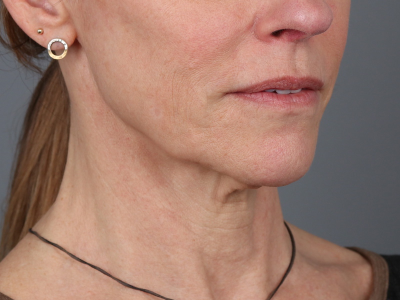 Neck Lift Before and After | Dr. Michael Kim